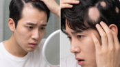 <b>"오빠, 갈수록 대문자 M자야"... 샴푸 바꾼다고 될 일 아닙니다, '탈모의 경고'</b>