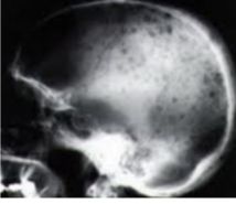 다발골수종 병변. /사진=서울아산병원