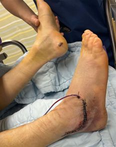 ▲지난 2월26일 대구출입국사무소 단속 과정에서 경북 경산시의 한 베트남인 이주노동자가 양발 뒤꿈치가 으깨지는 골절상을 입었다. ⓒ대구경북이주연대회의