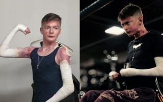 "진짜 끔찍해" 21세 男, '나비 피부병' 뭐길래