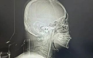 “숙취인 줄 알았지”…12㎝ 젓가락 목에 8년 꽂고 생활한 中 남성