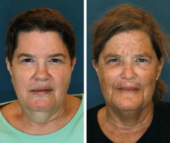 자외선 차단 여부에 따른 쌍둥이 자매의 노화 차이. Plastic and reconstructive surgery