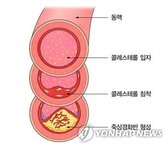 고지혈증[서울아산병원 제공]