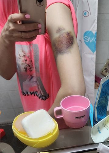 스토킹 범죄로 숨진 피해 여성의 유족이 사망 전 피해자가 가해 남성에게 팔에 피멍이 들 정도로 폭행을 당한 사진을 공개했다.