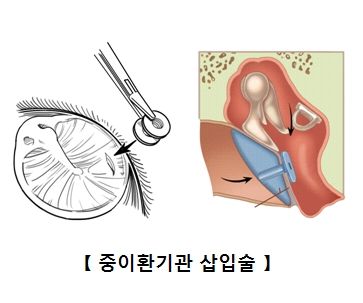 소아 중이염 치료를 위해 귀에 관을 집어넣는 수술. 병원에서 그림이 아닌 실제 수술 사진을 보면 더 가슴이 먹먹해진다. /사진=서울아산병원