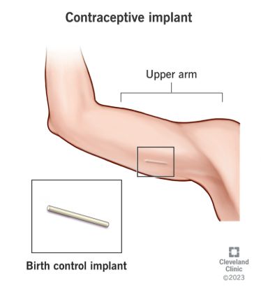 피부에 이식하는 피임 임플란트 예시