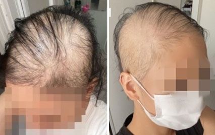 일본의 한 20대 여성이 지난 6월 말 모더나 백신 1차 접종을 한 뒤 탈모가 시작됐다며 공개한 사진. (블로그 갈무리) © 뉴스1