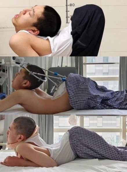 강직 척추염 진단을 받은 뒤 꾸준히 상태가 악화하던 장 씨는 뒤늦게 치료를 시작했다.