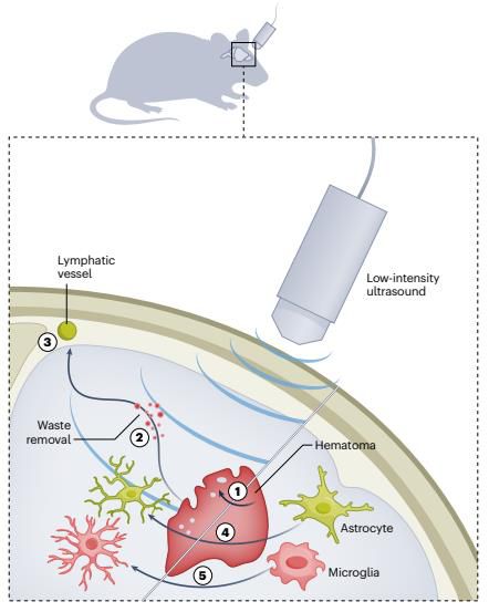 저강도 초음파를 이용한 출혈성 뇌졸중 쥐의 뇌 노폐물 제거 메커니즘두가지 형태의 뇌출혈(지주막하 출혈-뇌내/뇌실질 출혈)로 뇌졸중을 유도한 생쥐 모델의 뇌에 주파수 1㎒의 저강도 초점 초음파(LIFU)를 하루 20분씩 3차례 가하는 치료를 한 결과 손상 부위의 적혈구가 대조군보다 55~65% 감소하고 혈종 부피는 약 58% 줄어든 것으로 나타났다. 제거된 적혈구는 심경부 림프절에서 검출, 림프 경로로 배출된 것으로 확인됐다. 또 초음파 치료군은 미세아교세포(microglia)와 성상교세포(astrocyte) 활성이 각각 대조군보다 47%와 38%가 감소, 신경 염증 및 독성 반응도 크게 완화됐다. [Nature, Zachary Papadopoulos et al. 제공. 재판매 및 DB 금지]