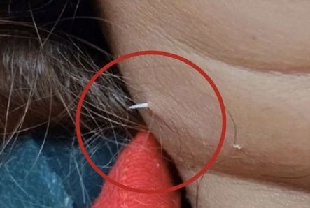 태국에서 40대 여성이 식사 중에 삼킨 생선 가시가 목 피부를 뚫고 나온 일이 발생했다. 페이스북 캡처