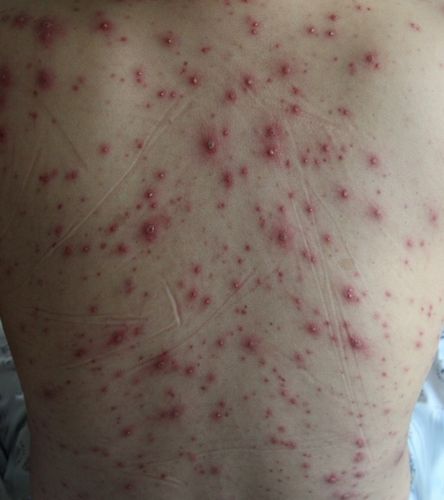 수두[서울대병원 제공]