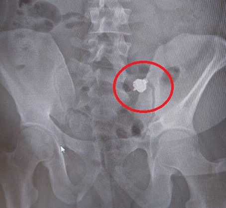 엑스레이 촬영 결과 드러난 이어폰 / 연합뉴스