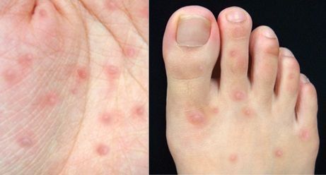 앤테로바이러스 감염에 의한 수족구 질환. 출처=서울대병원