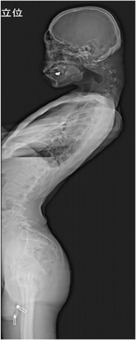 환자의 척추가 장기간의 부자연스러운 자세로 인해 크게 변형된 모습. 일본정형외과 학회지(JOS)의 사례 연구집 논문 캡처