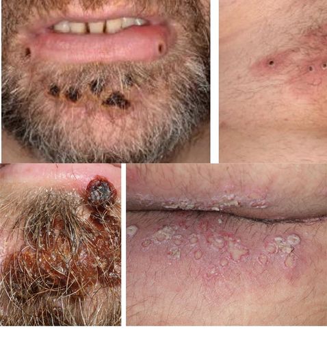 흑인이 아닌 원숭이두창 환자 사례[한국과[한국과학기자협회 제공. 재판매 및 DB 금지]학기자협회 제공. 재판매 및 DB 금지]