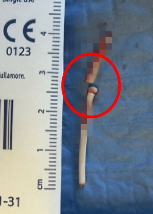 20대 미국 여성의 피부 아래에서 파손된 피임 임플란트의 모습. 온라인 의학 저널 큐레우스 제공