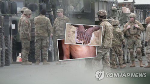 '확산' 원숭이두창 미군 첫 감염…미국, 백신 추가주문 (CG)[연합뉴스TV 제공]