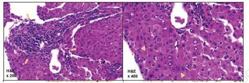 환자의 간 혈관에 괴사가 진행되는 모습[서울성모병원 제공]