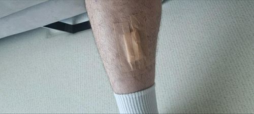 폭발한 세탁기 파편에 다친 다리제보자 A씨 제공. 재판매 및 DB 금지.