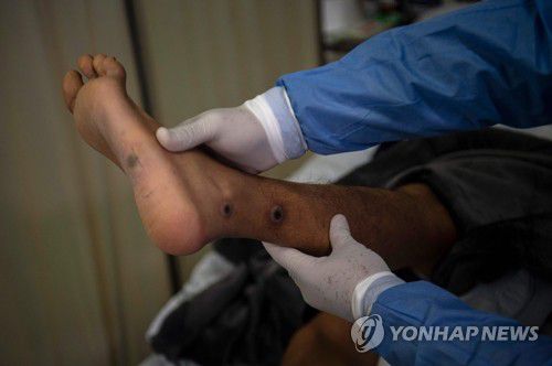 원숭이두창 환자 진료하는 페루 의료진(리마 AFP=연합뉴스) 16일(현지시간) 페루 리마의 원숭이두창 격리병동에서 한 의사가 원숭이두창 환자의 상처를 살펴보고 있다. 지난 석 달 동안 전 세계 확진자가 약 2만8천 명에 달했으며 유럽, 남미 등 아프리카 외 지역에서도 사망 사례가 잇따라 발생하고 있다. 2022. 08. 17 ddy04002@yna.co.kr