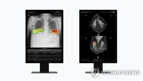 루닛 인사이트 CXR(왼쪽)와 루닛 인사이트 MMG[루닛 제공. 재판매 및 DB 금지]