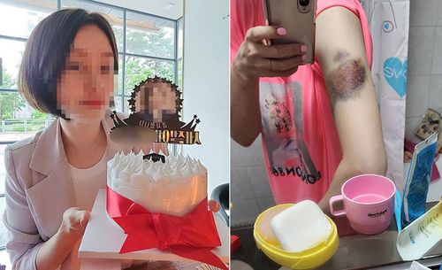 피해자의 살아생전 모습(왼쪽)과 폭행 피해로 멍이 든 모습.[온라인 커뮤니티 캡처. 재판매 및 DB 금지]