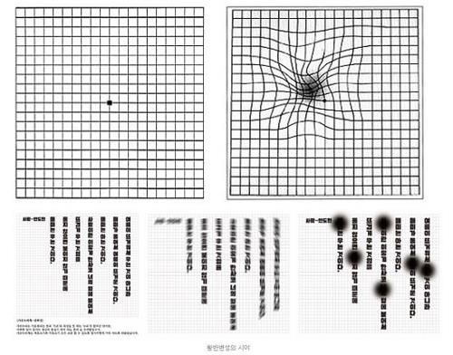 황반변성에 의한 변형시 모습 [자료사진]