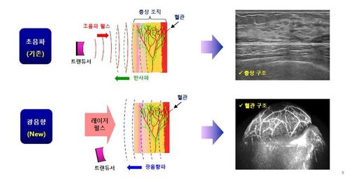 기존 초음파 내시경과 광음향 초음파 내시경 영상의 차이[비달소닉 제공. 재판매 및 DB 금지]