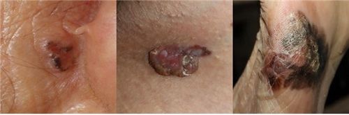 왼쪽부터 기저세포암, 편평세포암, 악성흑색종[서울대병원 제공]