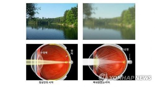 정상 눈과 백내장 눈의 시야 비교[김안과병원 제공]