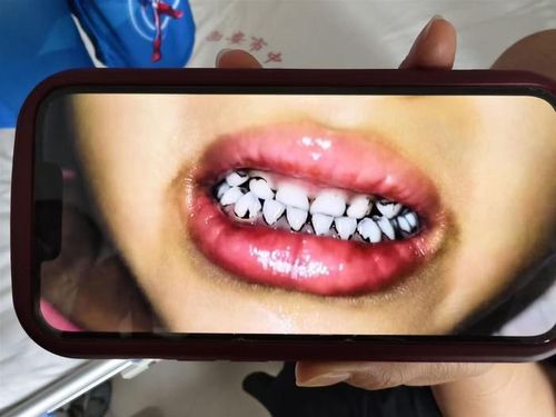 중국서 납중독 의심으로 치아 일부가 검게 변한 유치원생[중국 매체 지무뉴스 캡처. 재판매 및 DB금지]