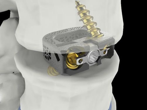 척추 융합기기 '유니스페이스(UniSpace® TPLIF Cage, 요추 케이지)' [시지메드텍 제공]
