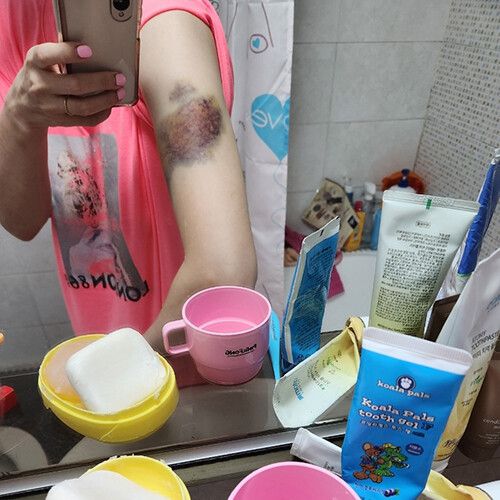 지난 8일 ‘네이트판’에 인천 스토킹 살인사건 피해자 유족이 공개한 피해자 생전 사진. 가해자에게 폭행을 당해 팔에 시커먼 멍이 들었다. 커뮤니티 갈무리