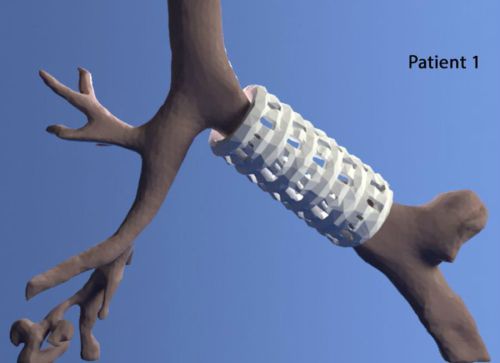 4D 의료용 부목. 출처=www.popsci.com