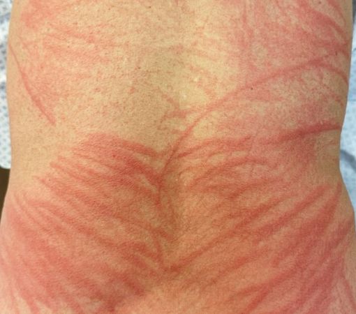 표고버섯 피부염을 앓고 있는 환자의 등. [사진=mitsukecc]