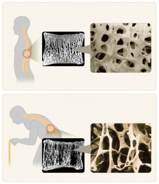 정상 상태의 뼈 조직(위)과 골다공증 환자의 뼈 조직(아래).  국가건강정보포털