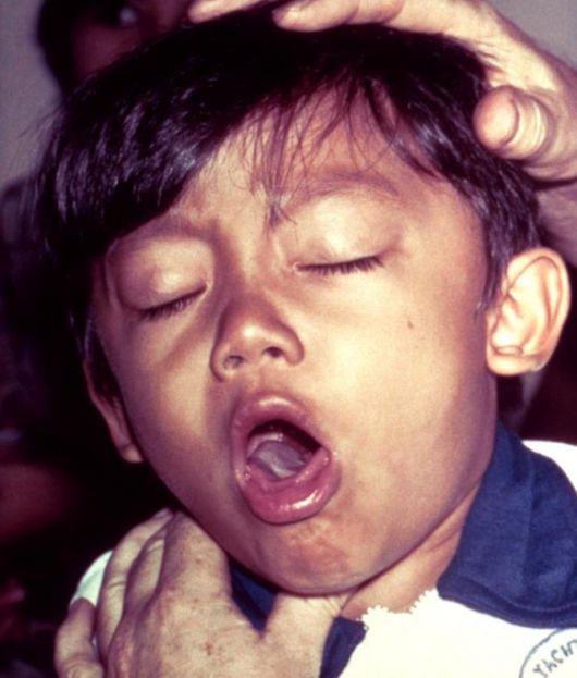 백일해 관련 이미지. 위키피디아