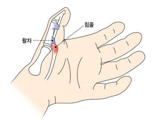 방아쇠 손가락과 관련된 힘줄과 활차의 설명도. 강동경희대병원 제공