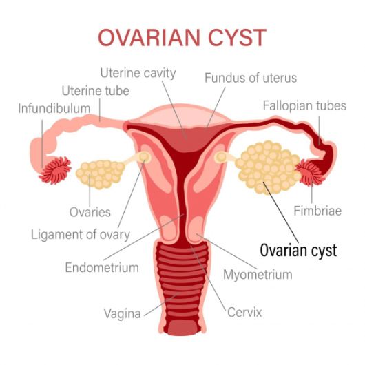 난소 낭종(ovarian cyst) 자료 이미지. 아이클릭아트