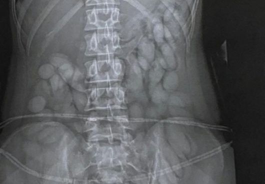 지난해 남아프리카공화국 요하네스버그 OR탐보 국제공항에서 뱃속에 마약을 넣어 운반한 나미비아 국적 30대 여성이 현지 경찰에 붙잡혔다. 남아프리카공화국 경찰 제공