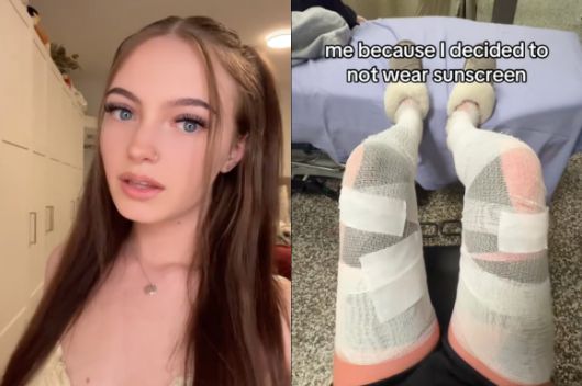 선크림을 바르지 않고 장시간 햇볕에 노출된 다리에 3도 화상을 입은 틱톡 인플루언서 테일러 페이스. 틱톡 (@.taylorfaith) 캡처