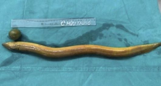 인도 남성의 뱃속에서 나온 65㎝ 크기 장어. 베트남뉴스 캡처