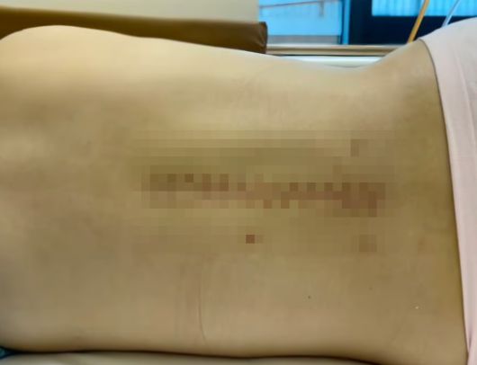 중국에서 남자친구가 몰던 차 조수석에 앉아 있다 교통사고가 나 하반신이 마비되는 사고를 겪은 20대 여성이 사고 이후 남자친구가 연락두절됐다고 주장해 공분이 일고 있다. 더우인