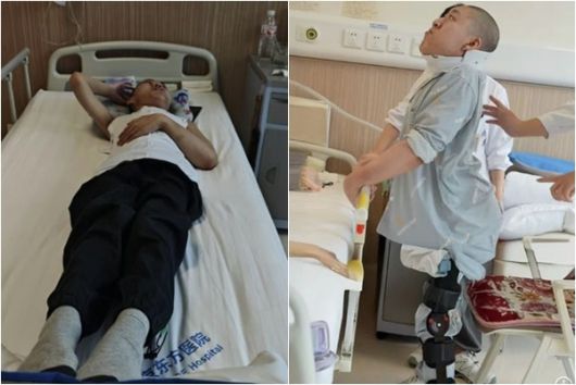 180도로 휘어진 척추로 인해 ‘폴더 소년(접힌 소년)’이라 불린 중국 청년이 대수술 끝에 몸을 곧게 펴는 데 성공했다. 의료진 제공·더우인 캡처