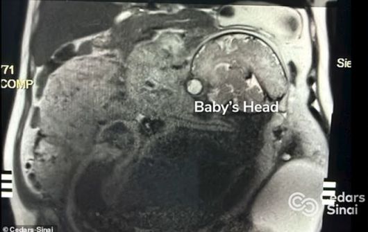 미국 캘리포니아에서 거대한 난소 종양 제거 수술을 앞두고 있던 한 여성이 임신 사실을 알게 된 뒤 며칠 만에 건강한 아기를 출산하는 기적이 일어났다. 사진=시더스-시나이 메디컬센터