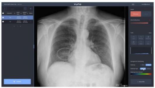 뷰노의 AI기반 엑스선 판독시스템/사진=뷰노