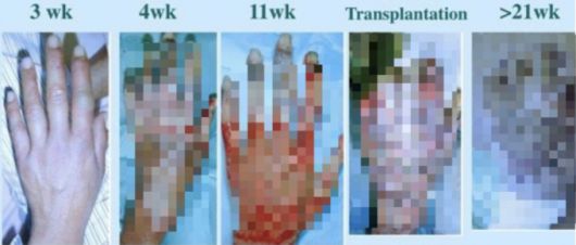 피폭이후 21주간 지켜본 작업자 오우치의 손. /사진=NHK 도카이무라 임계사고 취재반 '83일' 저서