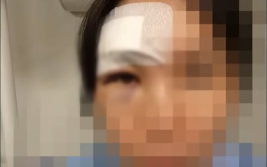 헬스장에서 지나가던 남성이 20kg짜리 바벨을 치는 바람에 뇌진탕 등으로 치료비 1000만원이 나왔다는 한 여성의 사연이 전해졌다. 보상을 약속했던 남성은 돌연 잠적했다./사진=JTBC '사건반장' 갈무리