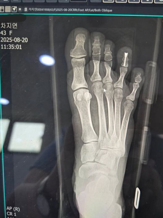 배우 차지연이 발가락 부상에도 공연에 대한 열정을 드러냈다. /사진=차지연 SNS