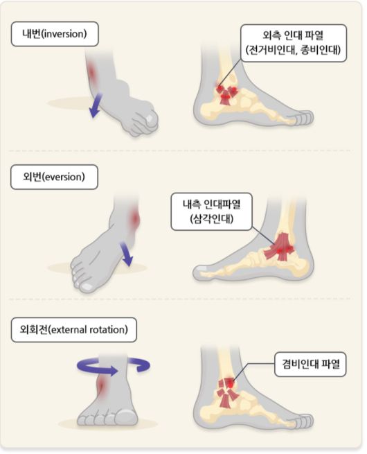 발목 인대를 다치는 방향. /자료=국가건강정보포털